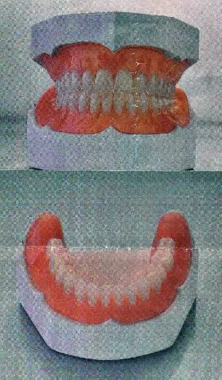 Sog. Zahnersatz aus Kunststoff, in Form einer zusammengesetzten Ware, bestehend aus einem einem je nach Ausführung ein- oder zweiteiligen Gebissmodell aus Gips, das mit einer ein- oder zweiteiligen Vollprothese aus Kunststoff versehen ist, die auf Grundlage eines zuvor bei dem Patienten  genommenen Abdrucks gefertigt wurde. Die Prothese bestimmt den Charakter der zusammengesetzen Ware im Hinblick auf die Bedeutung für die Verwendung. Der Zahnersatz dient der Wiederherstellung der geschlossenen Zahnreihe und damit der Kaufähigkeit des Patienten.
Zur äußeren Form (beispielhaft) siehe Abbildung in der Anlage. 
Die Ware wird als "künstliches Körperteil in Form künstlicher Zähne aus Kunststoff für Menschen" eingereiht.