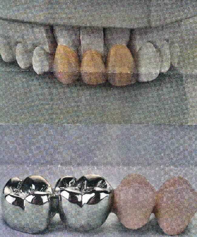 Sog. Zahnersatz aus unedlem Metall oder Keramik, in Form einer zusammengesetzten Ware, bestehend aus einem Gebissmodell aus Gips, das mit einer je nach Ausführung unterschiedlichen Anzahl von Zahnkronen (ggf. miteinander verbunden) aus unedlem Metall oder Keramik, die auf der Grundlage eines zuvor bei dem Patienten abgenommenen Gebissabdruckes gefertigt wurden, versehen ist. Die den sichtbaren Bereich der Zähne ersetzenden Kronen bestimmen den Charakter der zusammengesetzten Ware im Hinblick auf die Bedeutung für die Verwendung. Der Zahnersatz dient der Wiederherstellung der geschlossenen Zahnreihe und damit der Kaufähigkeit des Patienten. 
Zur äußeren Form  (beispielhaft) siehe Abbildung in der Anlage.
Die Ware wird als "künstliches Körperteil in Form künstlicher Zähne, nicht aus Kunststoff für Menschen" eingereiht.