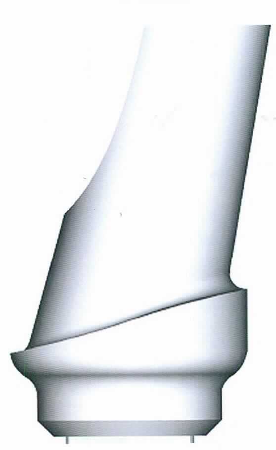 Abutment (künstlicher Zahnstumpf/Implantataufbau), sog. Contour-Abutment, abgewinkelt, für Plattform 3,2 mm (TRI-Narrow-Implantate), mit TRI-Friction, Art.-Nr. TN20-41-F, in Form einer Warenzusammenstellung in Aufmachung für den Einzelverkauf, bestehend aus einem zylindrischen, konischen, abgewinkelten (17°) Abutment aus einer Titanlegierung mit internem Sechskant und einem Durchmesser (Austrittsprofil) von 4,0 mm (charakterbestimmender Bestandteil im Hinblick auf die Verwendung) für eine zementierte Restauration sowie einer Halteschraube aus Titan Grad 5 (Art.-Nr. RS-TNV10).
Äußere Form: siehe Abbildung in der Anlage.
Das Abutment wird mit Hilfe der Schraube auf ein künstliches Zahnwurzelimplantat (nicht Gegenstand dieser Auskunft) geschraubt und dient so der Befestigung im Kiefer des Menschen. Anschließend wird der Aufbau mit der endgültigen Versorgung (ebenfalls nicht Gegenstand dieser Auskunft) versehen.
Die Bestandteile der Warenzusammenstellung sind gemeinsam in einer Blisterverpackung untergebracht.

Die Ware wird als "Teil, erkennbar hauptsächlich für eine Ware der Zahnprothetik der Position 9021 2900 bestimmt" eingereiht.
