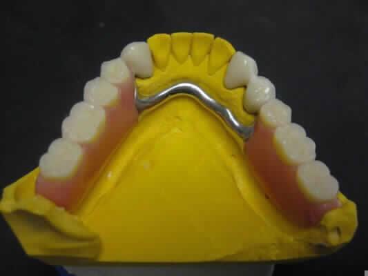 Sog. Zahnersatz aus Kunststoff, in Form einer zusammengesetzten Ware, bestehend aus einem Gebissmodell aus Gips, das mit einer je nach Ausführung mit künstlichen Zähnen aus Kunststoff versehenen Voll- oder Teilprothese, die auf der Grundlage eines zuvor bei dem Patienten abgenommenen Gebissabdruckes gefertigt wurde, versehen ist. Die Prothese bestimmt den Charakter der zusammengesetzten Ware im Hinblick auf die Verwendung. Der Zahnersatz dient der Wiederherstellung der geschlossenen Zahnreihe und damit der Kaufähigkeit des Patienten.
Äußere Form der Ware (beispielhaft) siehe Anlagen.

"Künstliches Körperteil in Form künstlicher Zähne aus Kunststoff, für Menschen"
