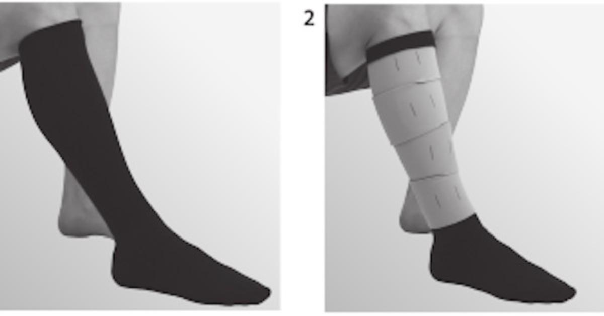 Kniestrümpfe, sog. Unterziehstrümpfe fest, in Erwachsenengröße, Foto siehe Anlage,
- aus bis zu ca. 1,7 mm dicken, buntgewirkten Gewirken aus laut Antrag 52 % Polyester, 37 % Nylon
  und 11 % Elasthan (alles synthetische Chemiefasern); mit einem Titer der einfachen Garne von
  augenscheinlich mehr als 67 dtex,
- schlauchförmig gewirkt und an den Fußspitzen durch Zusammennähen konfektioniert,
- mit ausgearbeitete Ferse,
- die Wade bedeckend, bis zum Knie reichend; stellen sich somit als Kniestrümpfe dar, damit keine
  Ware der Unterposition 6115 9699,
- am oberen Rand abgepasst gewirkt,
- laut Antrag werden die Strümpfe unter einer Kompressionsbandage getragen und weisen nur im
  Fuß-/Fesselbereich eine Kompression von 25-35 mmHg auf (damit nicht mit einer degressiven
  Kompression, die sich aufwärts in Richtung des Beines reduziert).

"Kniestrümpfe aus Gewirken, nicht mit degressiver Kompression, mit einem Titer der einfachen Garne
 von mehr als 67 dtex, aus synthetischen Chemiefasern"