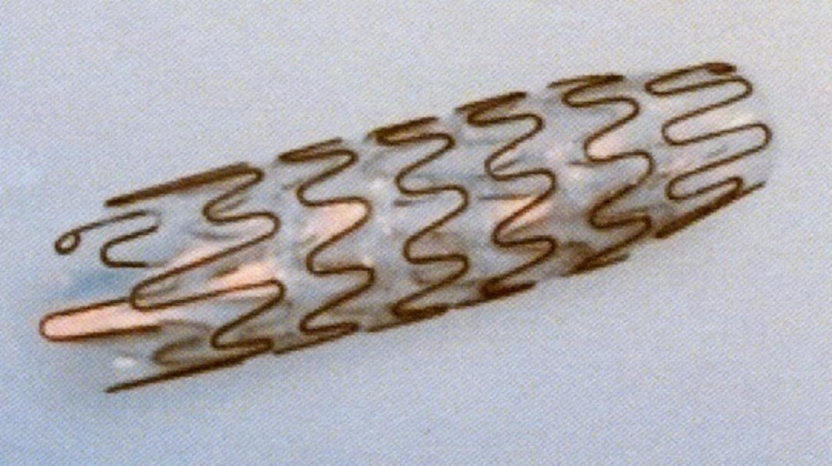 Sog. BUS Stent, Art.-Nr. REF 25.400.30.050, 25.400.30.060, 25.400.30.080, im Wesentlichen bestehend aus einem selbstexpandierenden, röhrenförmigen Stent aus einem Nitinol-Metallgeflecht, beschichtet mit einem nicht resorbierbaren CO-Polymer (verhindert ein Einwachsen in das Gewebe), in drei verschiedenen Längen (50, 60, 80 mm).

Zur äußeren Form siehe Abbildung in der Anlage

Der Stent wird mithilfe eines Einführsystems (nicht Gegenstand dieser vZTA-Entscheidung) dauerhaft in den menschlichen Körper implantiert, wo er selbstständig expandiert und eine Verengung überbrückt. Er wird bei Obstruktionen im urologischen Bereich (z. B. Harnröhrenstrikturen) verwendet.

Die Ware wird als "Vorrichtung zum Implantieren in den menschlichen Körper, zum Beheben eines Funktionsschadens, nicht von den Unterpositionen (KN) 9021 1010 bis 9021 9010 erfasst" eingereiht.