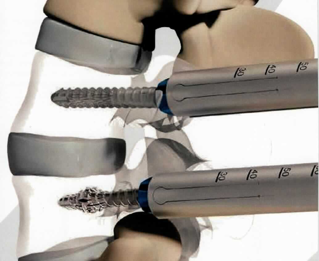 Sog. expandierbare Schraube, in Form einer massiven zylindrischen Ware aus Titan, im Wesentlichen bestehend aus einem polyaxialen, U-förmigen Schraubenkopf mit Innengewinde und einem mit einem Außengewinde versehenen Schaft mit einem Durchmesser von 6,5 mm oder 7,5 mm, einer Länge von 40 mm, 45 mm, 50 mm oder 55 mm und mit einer 17 mm langen Expansionszone, welche sich beim Eindrehen in das Material aufweitet. 

äußere Form: siehe Abbildung in der Anlage

Die Schraube wird als Bestandteil eines Systems zur Stabilisierung der Wirbelsäule (nicht Gegenstand dieser vZTA-Entscheidung) bei verschiedenen Deformitäten und Erkrankungen der Wirbelsäule (Frakturen der Brust- und Lendenwirbelsäule, Spondylolisthese, degenerative diskogene Bandscheibenerkrankungen) in den Körper des Patienten implantiert.

Die Ware wird als "Teil, erkennbar hauptsächlich bestimmt für eine Vorrichtung zum Behandeln von Knochenbrüchen" eingereiht.