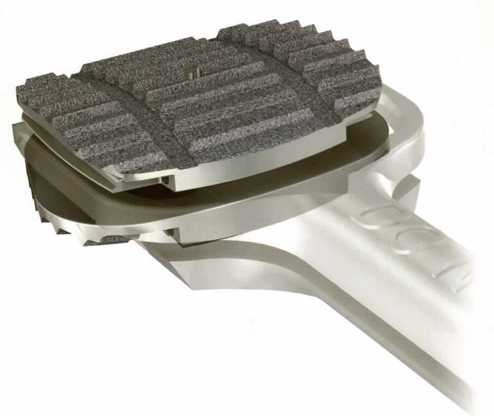 Sog. Bandscheibenprothese, im Wesentlichen bestehend aus einer noch nicht zusammengesetzten, speziell geformten Vorrichtung aus zwei gezahnten Deckplatten aus Titan, welche über ein Keramikgelenk miteinander verbunden werden. 

äußere Form: siehe Abbildung in der Anlage

Die Prothese wird zur Wahrung der physiologischen Mobilität der Wirbelsäule im Rahmen der Behandlung von degenerativen Bandscheibenerkrankungen, Bandscheibenvorfällen, Myelopathien in Verbindung mit einer spondylotischen Stenose des Foramens oder des Kanals oder Wurzelerkrankungen in Verbindung mit neurologischer Defizienz in den Zwischenwirbelraum im Bereich der Halswirbelsäule von C3 bis C7 implantiert und dient als Bandscheibenersatz.

Die Ware wird "als künstliches Körperteil für Menschen, nicht von den Unterpositionen (KN) 9021 1010 bis 9021 3910 erfasst" eingereiht.
