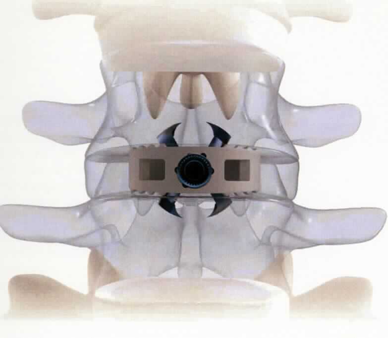 Sog. Platzhalter lumbale Wirbelsäule, in Form einer anatomisch geformten, ringartigen Vorrichtung, oben und unten mit geriffelter Oberflächenstruktur, welche über einen integrierten Fixierungsmechanismus in Form von vier gegenläufig um eine Achse rotierenden Haken verfügt.

äußere Form: siehe Abbildung in der Anlage

Die Ware wird als Abstandhalter für die Wirbelsäule zur anterioren lumbalen Zwischenwirbelfusion bei Patienten mit degenerativen Bandscheiben auf einer oder zwei angrenzenden Ebenen in den menschlichen Körper implantiert und dient als Bandscheibenersatz.

Sie wird als "künstliches Körperteil für Menschen, nicht von den Unterpositionen (KN) 9021 1010 bis 9021 3910 erfasst" eingereiht.