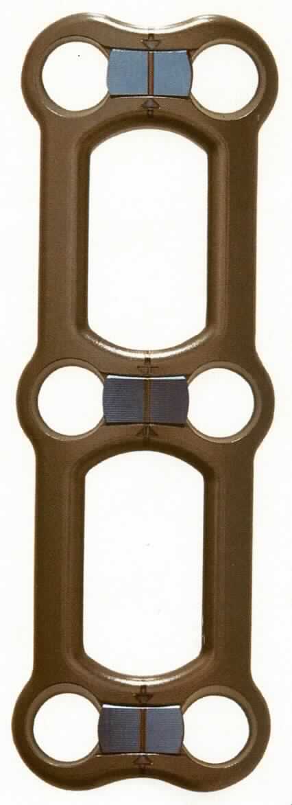 Sog. ventrale HWS-Platte, in Form einer noch nicht zusammengesetzten Ware, bestehend aus 
- einer anatomisch vorgeformten mono- oder polysegmentalen Platte aus einer Titanlegierung in unterschiedlichen Längen, mit einer Breite von 16 mm und einer Höhe von 2,3 mm sowie 
- einer den Fixierungsvorgaben der Platte entsprechenden Anzahl farbkodierter selbstbohrender bzw. selbstschneidender Knochenschauben aus einer Titanlegierung in unterschiedlichen Längen und Durchmessern.

äußere Form: siehe Abbildung in der Anlage

Das Plattensystem wird dauerhaft in den menschlichen Körper implantiert und dient der Stabilisierung der Halswirbelsäule bei Frakturen, Spondylolisthese, Pseudoarthrose, degenerativen Bandscheibenerkrankungen, Spinalstenose, Tumoren und Versagen einer vorherigen Fusion. 

Die Ware wird als "Vorrichtung zum Behandeln von Knochenbrüchen" eingereiht.