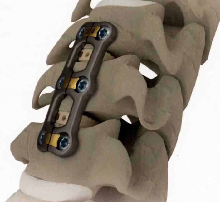 Sog. ventrale HWS Platte, in Form einer unvollständigen Ware, im Wesentlichen bestehend aus einer anatomisch vorgeformten mono- oder polysegmentalen Platte aus einer Titanlegierung in unterschiedlichen Längen, mit einer Breite von 16 mm und einer Höhe von 2,3 mm.

äußere Form: siehe Abbildung in der Anlage

Die Vorrichtung wird mit Hilfe von selbstbohrenden oder selbstschneidenden Kochenschrauben (nicht Gegenstand dieser vZTA-Entscheidung) dauerhaft in den menschlichen Körper implantiert und dient der Stabilisierung der Halswirbelsäule bei Frakturen, Spondylolisthese, Pseudoarthrose, degenerativen Bandscheibenerkrankungen, Spinalstenose, Tumoren und Versagen einer vorherigen Fusion. 

Die Ware wird als "Vorrichtung zum Behandeln von Knochenbrüchen" eingereiht.