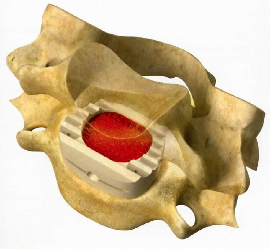 Sog. medizinisches Implantat, im Wesentlichen bestehend aus einer anatomisch geformten, ringartigen Vorrichtung aus PEEK-Optima. Die befüllbare Vorrichtung verfügt oben und unten über eine geriffelte Oberflächenstruktur und ist seitlich mit einer Öffnung mit Innengewinde versehen. 

äußere Form: siehe Abbildung in der Anlage

Die Vorrichtung wird zur Stabilisation im Rahmen der Behandlung eines zervikalen Bandscheibenvorfalls, einer Osteophytose oder degenerativer Instabilität des Zwischenwirbelbereichs zwischen zwei Wirbeln in die Halswirbelsäule des Patienten implantiert und dient als Bandscheibenersatz in der Halswirbelsäule.

Die Ware wird als "künstliches Körperteil für Menschen, nicht von den Unterpositionen (KN) 9021 1010 bis 9021 3910 erfasst" eingereiht.