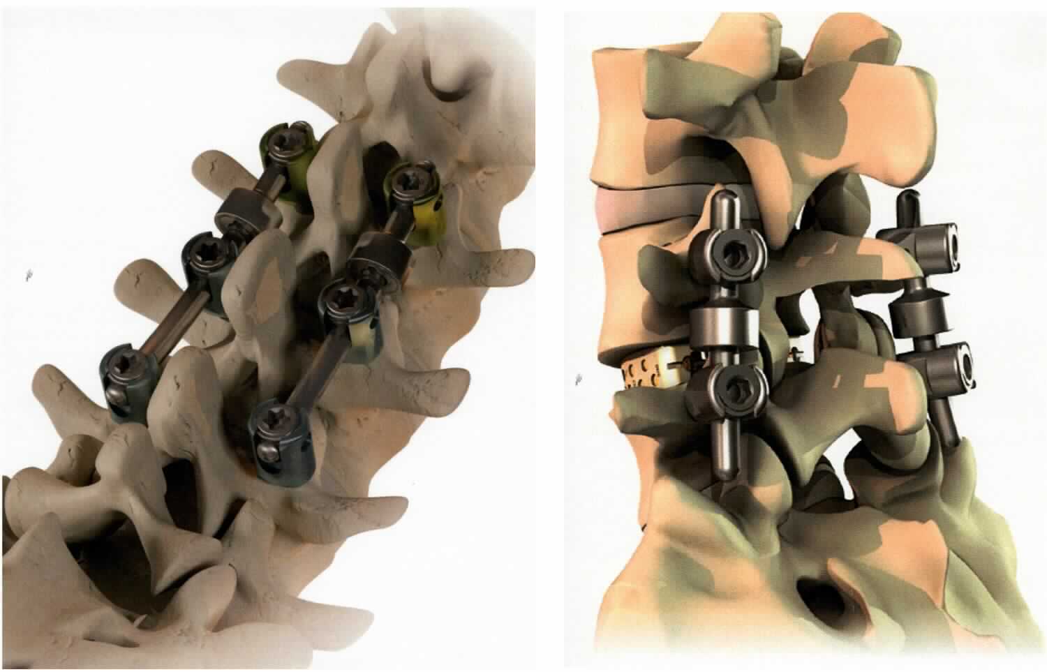 Sog. dynamische Versorgung, in Form eines zylindrischen Stabes aus Titan mit einem Durchmesser von 5,5 mm, in unterschiedlichen Längen von 50 mm bis 400 mm, beidseitig abgerundet mit einer oder zwei Verdickungen, durch welche einseitig eine limitierte Beweglichkeit des Stabes in 3 Ebenen ermöglicht wird. 

äußere Form: siehe Abbildung in der Anlage

Die Vorrichtung wird bei unterschiedlichen Indikationen wie zum Beispiel Instabilitäten, Spondyloslithese, Erschlaffung der Bandscheibe, Spinalkanalstenose oder degenerativer Skoliose in Verbindung mit verschiedenen Systemen zur Stabilisierung der Wirbelsäule dauerhaft in den menschlichen Körper implantiert. 

Die Ware wird als "Teil, erkennbar hauptsächlich bestimmt für eine Vorrichtung zum Behandeln von Knochenbrüchen" eingereiht.