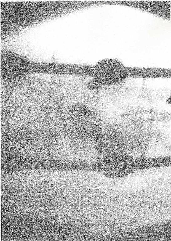 Sog. Frakturversorgung, in Form einer zusammengesetzten Ware, bestehend aus einem kanülierten Einführinstrument aus Stahl und einem charakterbestimmenden Implantat aus einer Kombination aus einer Titanlegierung und reinem Titan mit elektrolytischer Konversionsbeschichtung. 

äußere Form: siehe Abbildung in der Anlage

Das Implantat wird mit Hilfe des Einbringinstruments in den defekten Wirbelkörper eingebracht, dort entfaltet und anschließend mit röntgendichtem Knochenzement (nicht Gegenstand dieser vZTA-Entscheidung) befüllt.
Die Vorrichtung dient der internen Fixierung von Wirbelsäulenkompressionsfrakturen in der Brust- und Lendenwirbelsäule. 

Die Ware wird als "Vorrichtung zum Behandeln von Knochenbrüchen, einschließlich Verrenkungen und Gelenkverletzungen" eingereiht.