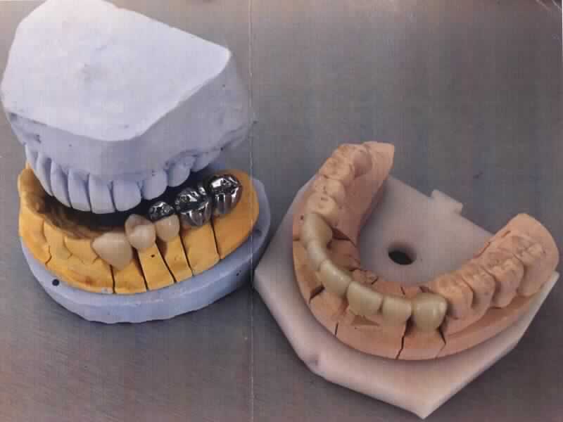 Sog. Zahnersatz, in Form einer zusammengesetzten Ware aus einem zahntechnischen Gebissmodell aus Gips und einer je nach Ausführung unterschiedlichen Anzahl von künstlichen Zähnen in Form von Zahnkronen oder Brückengliedern aus einem Metall- oder Keramikgerüst mit einer Verblendung aus Keramik. 
Die Kronen bzw. Brücken werden auf der Grundlage eines zuvor bei dem Patienten abgenommenen Gebissabdruckes gefertigt und in das Gebissmodell eingegliedert. 
Äußere Form: siehe beispielhafte Abbildung in der Anlage.
Die den sichtbaren Bereich der Zähne ersetzenden Kronen bzw. Brücken bestimmen den Charakter der zusammengesetzten Ware im Hinblick auf die Bedeutung für die Verwendung. Sie werden von dem behandelnden Zahnarzt aus dem Modell entnommen und anschließend in das Gebiss des Patienten eingegliedert. Der Zahnersatz dient der Wiederherstellung der geschlossenen Zahnreihe und damit der Kaufähigkeit des Patienten. 

Die Ware wird als "künstliches Körperteil in Form von künstlichen Zähnen, aus anderen Stoffen als Kunststoff, für Menschen" eingereiht.
