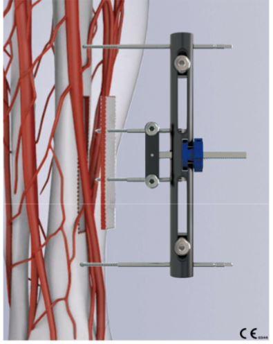 Sog. Transversales Tibia Transport (TTT)-System, in Form einer Warenzusammenstellung in Aufmachung für den Einzelverkauf, bestehend aus einem sog. Central Body TTT, in Form eines externen Fixateurs bestehend aus einer Rahmenkonstruktion aus zwei übereinanderliegenden, mittels einer Schraubvorrichtung  miteinander verbundenen Spannelementen, einer 3-Loch- und einer 5-Loch-Bohrführung, einem Inbusschlüssel, einem Bohrer mit einem Durchmesser von 2 mm und einer Länge von 120 mm sowie einer rechteckigen mit zwei Öffnungen versehenen Führungsplatte. Zur äußeren Form siehe Abbildung in der Anlage. Charakterbestimmend im Hinblick auf die Bedeutung für die Verwendung sind der sog. Central Body TTT und die beiden besonders geformten Bohrführungen.  
Der Central Body TTT wird mittels des Inbusschlüssels an vier Schanzschrauben (nicht Gegenstand dieser vZTA-Entscheidung) befestigt, die in die Tibia und die u.a. unter Zuhilfenahme der Führungsplatte, der Bohrführungen und des Bohrers aus dieser herausgelöste Knochenscheibe eingebracht wurden. Er dient der Durchführung eines transversalen Knochentransportes an der proximalen Tibia zur Behandlung von schweren Diabetischen Fuß Ulcera (DFU), Morbus Buerger, Arteriosklerose Obliterans (ASO) und schweren chronischen Geschwüren auf der Basis der Distraktionshistogenese. Hierbei wird die herausgelöste Knochenscheibe über mehrere Tage hinweg schrittweise vom Knochen weg und anschließend wieder zurück in die ursprüngliche Position bewegt. 
Eine orthopädische Vorrichtung im Sinne der Position 9021 liegt nicht vor, da die Ware weder dem Verhüten oder Korrigieren körperlicher Fehlbildungen oder dem Stützen und Halten von Körperteilen oder Organen nach Krankheit, Operation oder Verletzung dient. 
Die Bestandteile der Warenzusammenstellung sind gemeinsam miteinander in einem Karton verpackt. 

Die Ware wird als "medizinisches Instrument, nicht von den Unterpositionen (KN) 9018 1100 bis 9018 9075 erfasst" eingereiht.