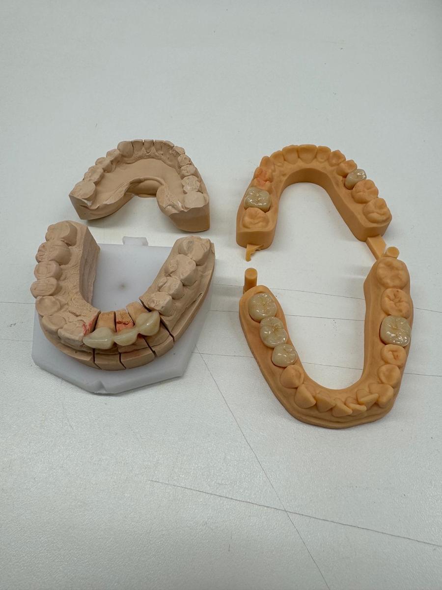 Sog. Zahnersatz, in Form einer zusammengesetzten Ware, im Wesentlichen bestehend aus einem zahntechnischen Gebissmodell aus Gips und Kunststoff auf einer Trägerplatte, das mit einer je nach Ausführung unterschiedlichen Anzahl von künstlichen Zähnen in Form von Zahnkronen oder Brückengliedern aus einem Metall oder Keramikgerüst mit einer Verblendung aus Keramik bestückt ist. 
Äußere Form siehe beispielhafte Abbildung in der Anlage.
Die Kronen bzw. Brücken werden auf der Grundlage eines zuvor beim Patienten abgenommenen Gipsabdrucks oder Intraoralscanns gefertigt und in das Gebissmodell eingegliedert. Die den sichtbaren Bereich der Zähne ersetzenden Kronen bzw. Brücken bestimmen den Charakter der zusammengesetzten Ware im Hinblick auf die Bedeutung für die Verwendung. Sie werden von dem behandelnden Zahnarzt aus dem Modell genommen und anschließend in das Gebiss des Patienten eingegliedert. Der Zahnersatz dient der Herstellung der geschlossenen Zahnreihe und damit der Kaufähigkeit des Patienten. 

Die Ware wird als "künstliches Körperteil in Form von künstlichen Zähnen, aus anderen Stoffen als Kunststoff, für Menschen" eingereiht.