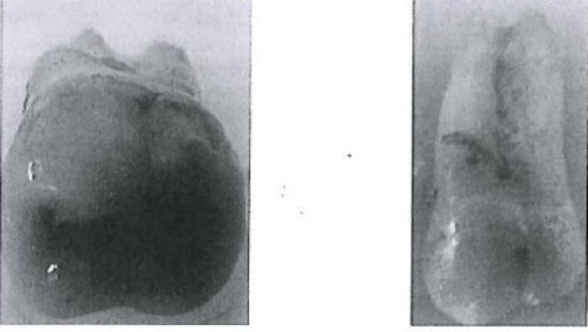 Nach den Angaben der Antragstellerin handelt es sich um extrahierte Zähne von Menschen. Die Zähne sind durch einen Reinigungsvorgang von z.B. Blut und Geweberesten befreit und haben darüber hinaus keine weiteren Be- oder Verarbeitungen erfahren.
Für den Transport sind die Zähne in einer 0,5%igen Chloramin-T-Lösung eingelegt. Derartige Humanzähne werden in der Industrie (Zahnygiene/Kosmetik), der Forschung oder zu Ausbildungszwecken verwendet.

Die Humanzähne werden unter Anwendung der AV 4 eingereiht, da eine Einreihung unter Anwendung der AV 1 bis AV 3 nicht möglich ist. Zolltarifrechtlich handelt es sich daher um Elfenbein, da menschliche Zähne den Tierzähnen am ähnlichsten sind.