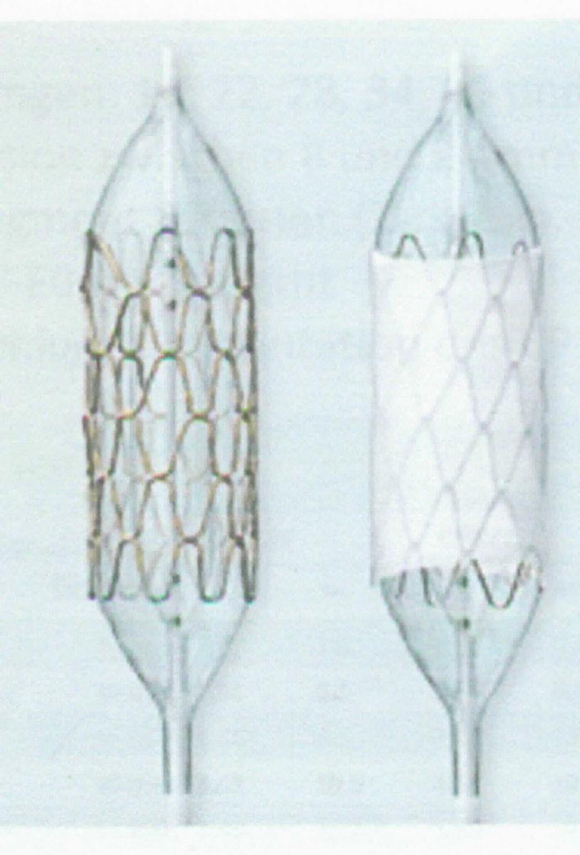 Kardiologischer Stent, sog. vormontierter CP Stent, in Form einer zusammengesetzten Ware, in zwei unterschiedlichen Ausführungen und in verschiedenen Längen (16, 22, 28, 34, 39 und 45 mm), im Wesentlichen bestehend aus einem röhrenförmigen, den Charakter der Ware bestimmenden Platin/Iridium-Drahtgeflecht (Stent-Röhrchen) in einem Zick-Zack-Muster mit 8 Rauten pro Segment, je nach Ausführung entweder unbeschichtet oder mit einer dehnbaren Hülle aus ePTFE überzogen, bereits an einem sog. BIB-Ballonkatheter vormontiert. Die Kreuzpunkte des Drahtgeflechts sind mit Gold beschichtet. 
Äußere Form: siehe Abbildung in der Anlage.
Die Ware wird in die Aorta vorgeschoben. Durch den Ballon-In-Ballon-Katheter (BIB) wird der Stent durch den inneren Ballon vordilatiert und anschließend durch den äußeren Ballon auf den gewünschten Durchmesser gebracht. Der zu expandierende Stent ist zur Anwendung bei Aortenstenosen vorgesehen. Die Expansion ist zwischen 8 mm und 24 mm möglich.

Die Ware wird als "Vorrichtung zum Implantieren in den menschlichen Körper, zum Beheben von Funktionsschäden, nicht von den Unterpositionen (KN) 9021 1010 bis 9021 9010 erfasst" eingereiht.